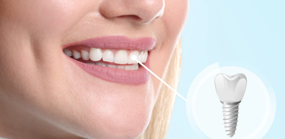 A Game-Changer for Full Mouth Restoration