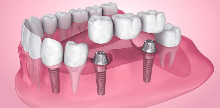 Dental Implants in Dubai - Restoring Your Smile with Precision