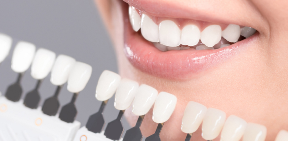 Porcelain vs. Composite Dental Veneers