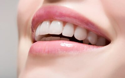 Teeth Whitening Options in Dubai