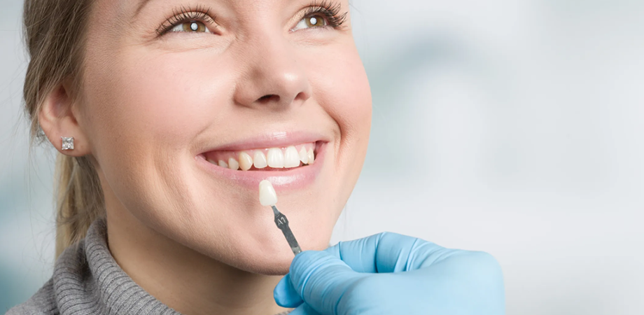 The Benefits of Dental Veneers