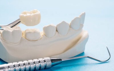 Understanding Dental Bridge Teeth in Restorative Dentistry
